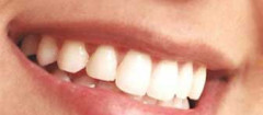 implantes-dentarios-joao-pessoa-1411740119