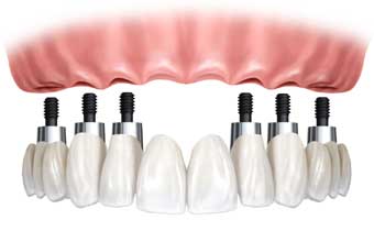 Prótese Dentária Manoel Gonçalves - Foto 1